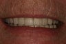 Full mouth rehabilitation.