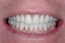 Full Mouth Reconstruction