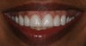 Veneers, gumlift