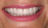 Porcelain crowns