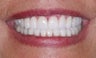 Smile makeover