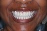 Smile makeover