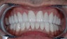 Smile Makeover with Porcelain Crowns
