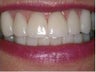 Smile Makeover Treatment
