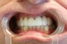 Smile Makeover