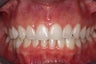 Braces, Gingivectomy, Bonding, Porcelain Crowns, Implant