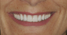 Smile makeover