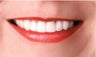 Smile Makeover