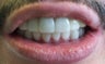 Snap-on Smile