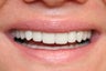 veneer and crown work