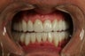 smile makeover with porcelain veneers