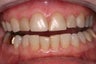 Full Mouth Reconstruction