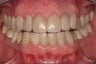 replacement of old restorations and new smile design