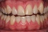porcelain crowns