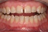 porcelain crowns to close space