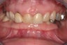 full mouth rehab