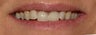 Veneers