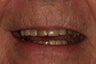Full mouth rehabilitation.