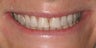 Porcelain crowns