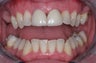 Invisalign, implants, whiteing and veneers
