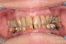 Smile makeover