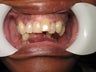 Smile makeover