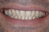 Smile Makeover with Porcelain Crowns