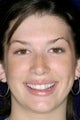 Porcelain Veneers