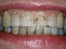 Smile Makeover Treatment