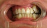 Smile Makeover