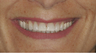 Smile makeover