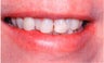 Smile Makeover