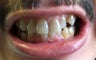 Snap-on Smile