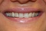 veneer and crown work