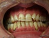 smile makeover with porcelain veneers