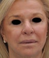 TCA Full-Face Chemical Peel