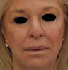 TCA Full-Face Chemical Peel