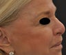 TCA Full-Face Chemical Peel