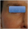 TCA Peel - Lower Lids