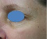 TCA Chemical Peel