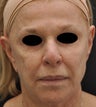 TCA Full-Face Chemical Peel