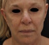 TCA Full-Face Chemical Peel