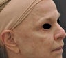 TCA Full-Face Chemical Peel