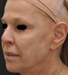 TCA Full-Face Chemical Peel