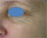 TCA Chemical Peel
