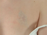 Tattoo Removal