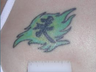 Tattoo Removal