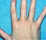 QSR Ruby Laser Tattoo Removal