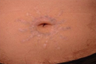 QSR Ruby Laser Tattoo Removal