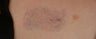 QSR Ruby Laser Tattoo Removal